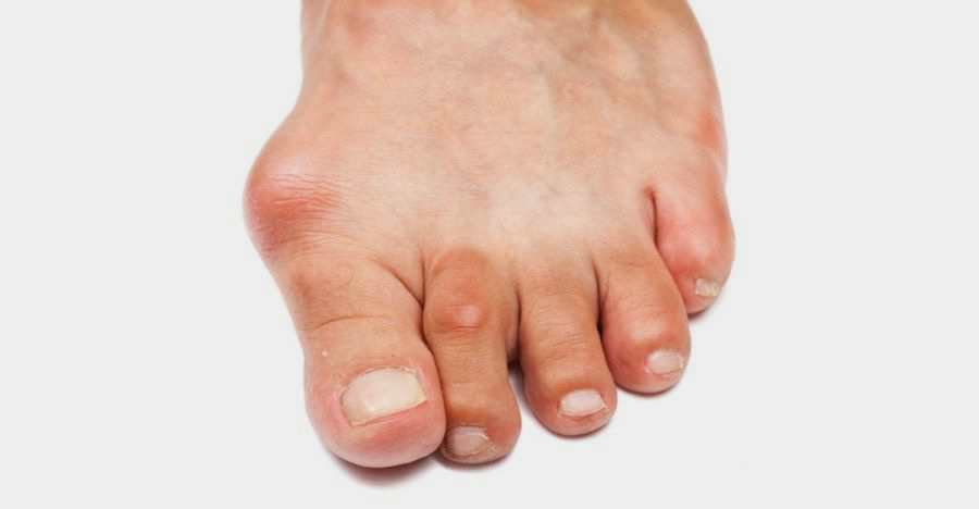 Молоткообразная деформация пальцев стопы