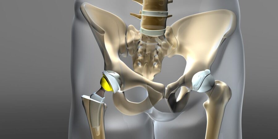 Титановый тазобедренный эндопротез. Implantcast тазобедренный сустав. Эндопротез тазобедренного сустава Германия. Искусственный сустав.